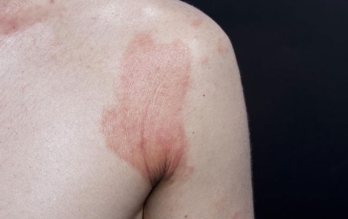 Understanding Contact Dermatitis: Symptoms, Causes, and Remedies