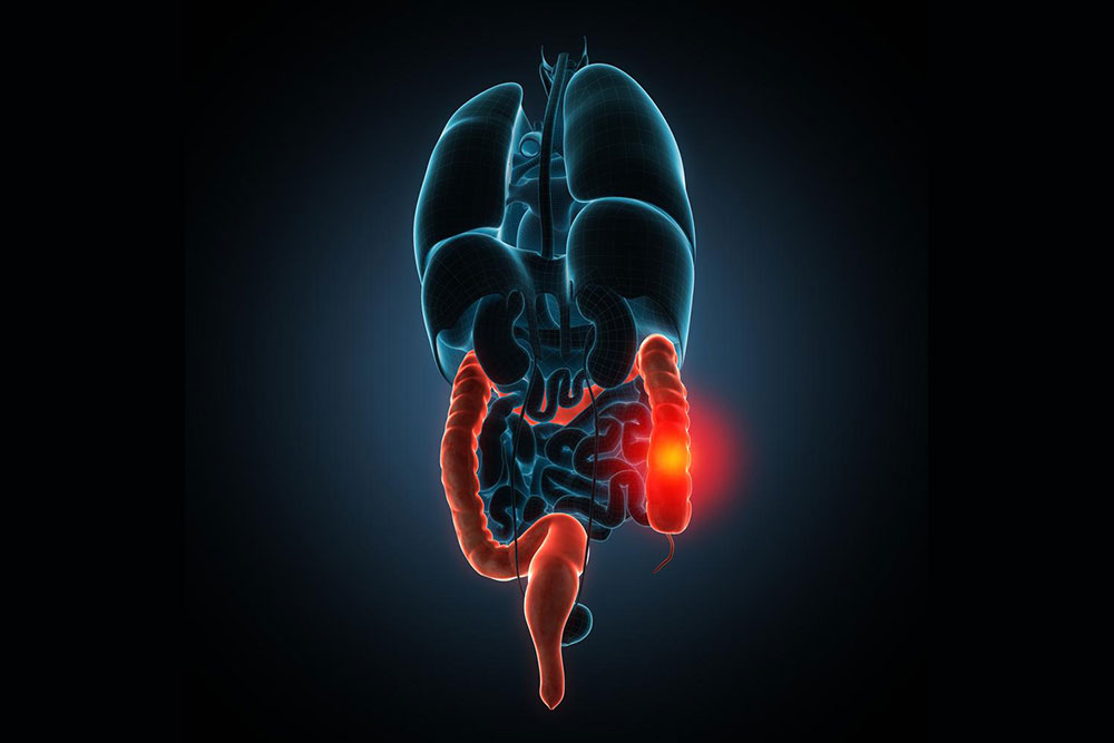 Understanding the Symptoms and Signs of Colitis