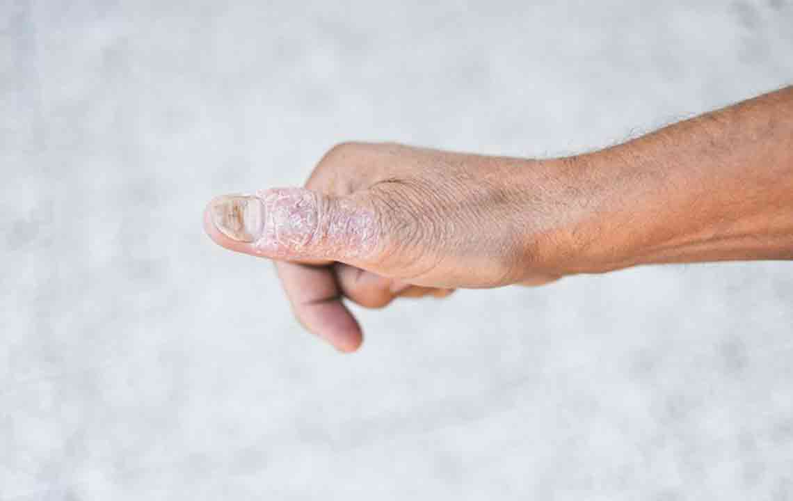 Holistic Approaches to Managing Lupus Skin Manifestations