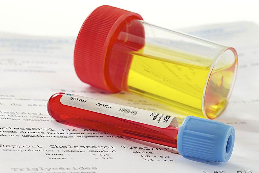 Top 4 Causes of Blood in Urine You Should Know
