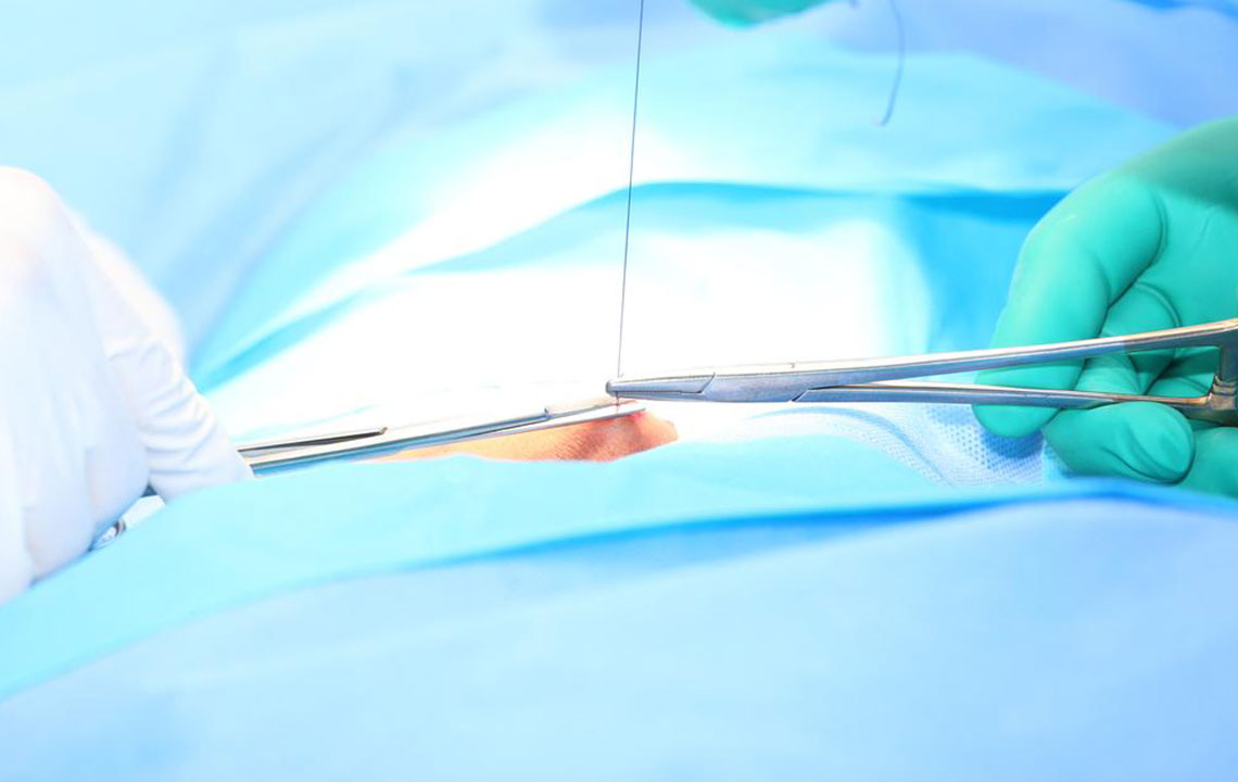 Effective Approaches to Managing Hiatal Hernia and Related Medications