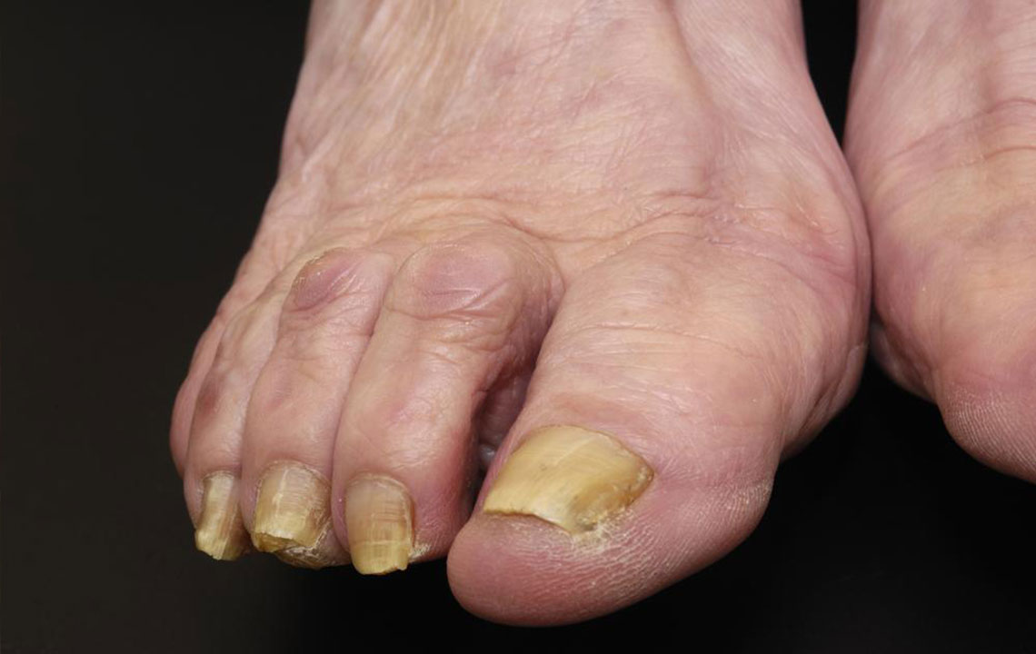 Effective Natural Remedies for Treating Nail Fungal Infections