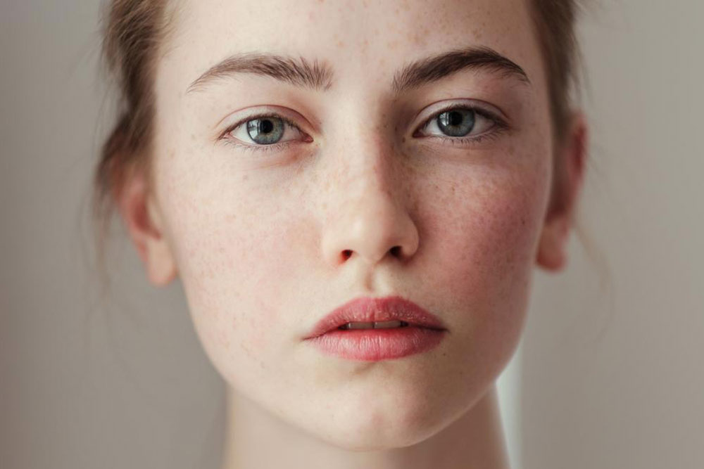 Effective Natural Remedies for Freckle Removal