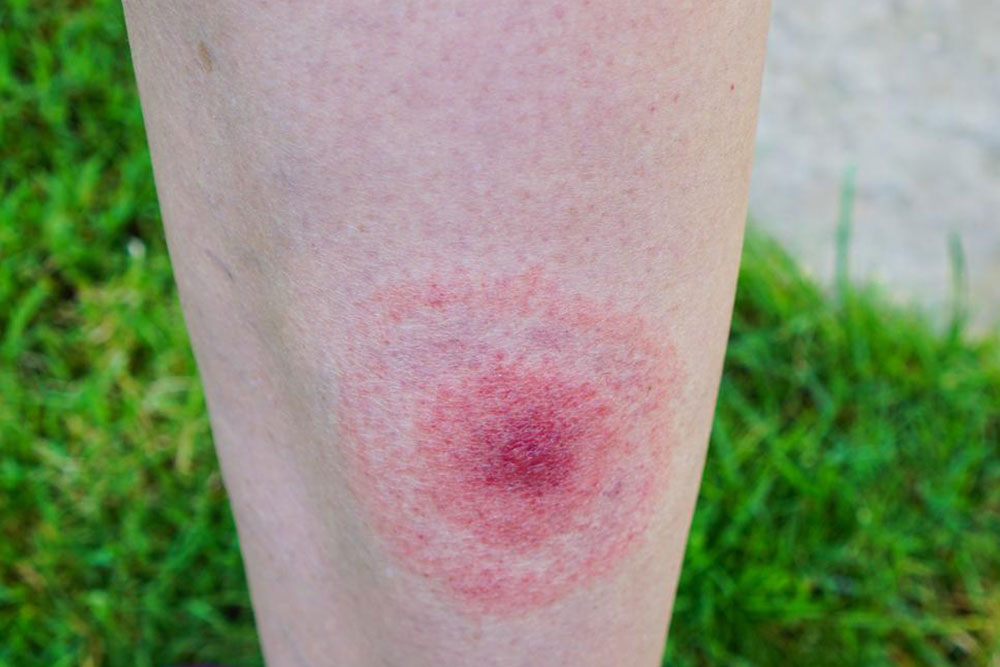 Recognizing the Early Symptoms of Lyme Disease