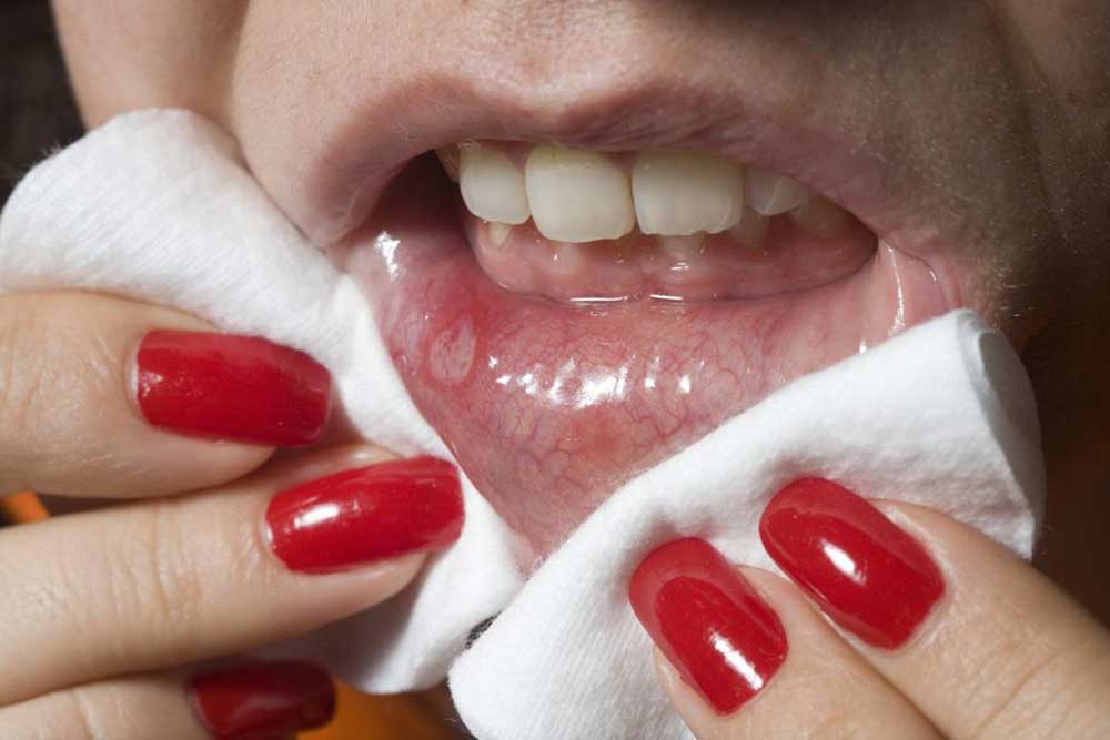 Understanding Oral Cancer: Causes, Symptoms, and Prevention