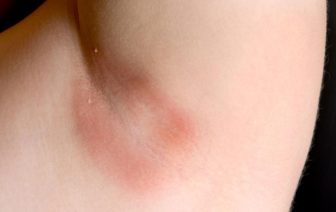 Natural Remedies to Heal Underarm Rash Caused by Waxing