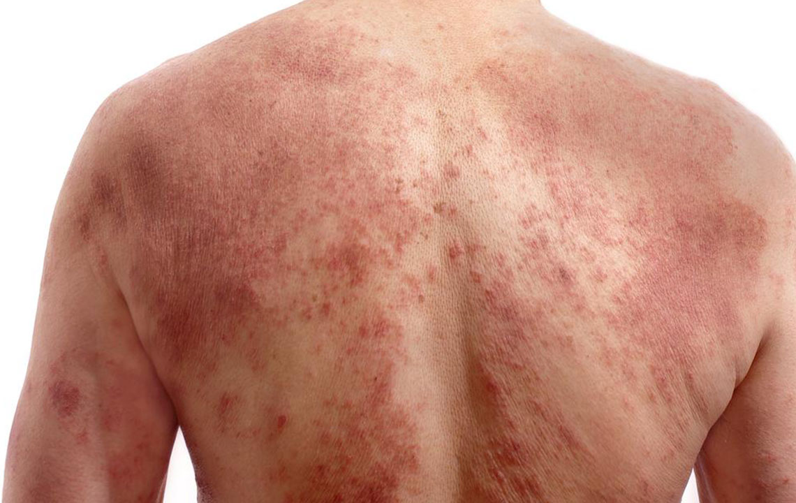Effective Topical Solutions for Rosacea Relief