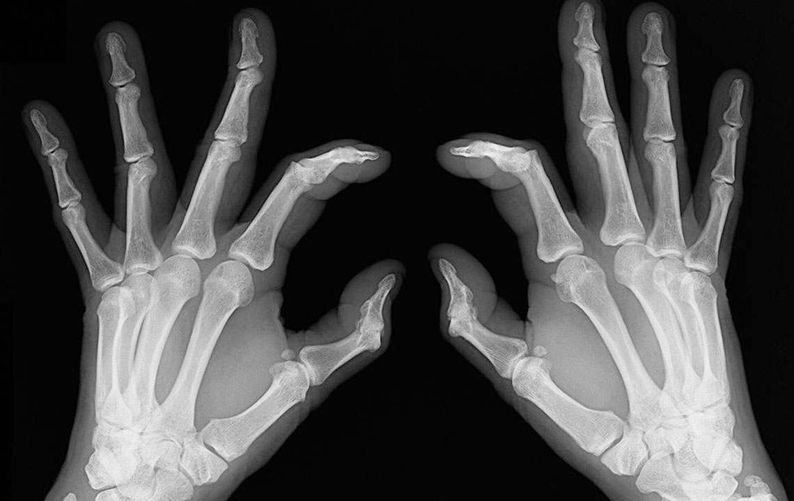 Comprehensive Guide to Recognizing Early Symptoms and Detecting Rheumatoid Arthritis