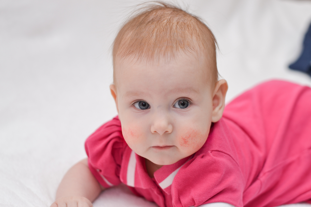 Essential Information About Eczema Management and Prevention