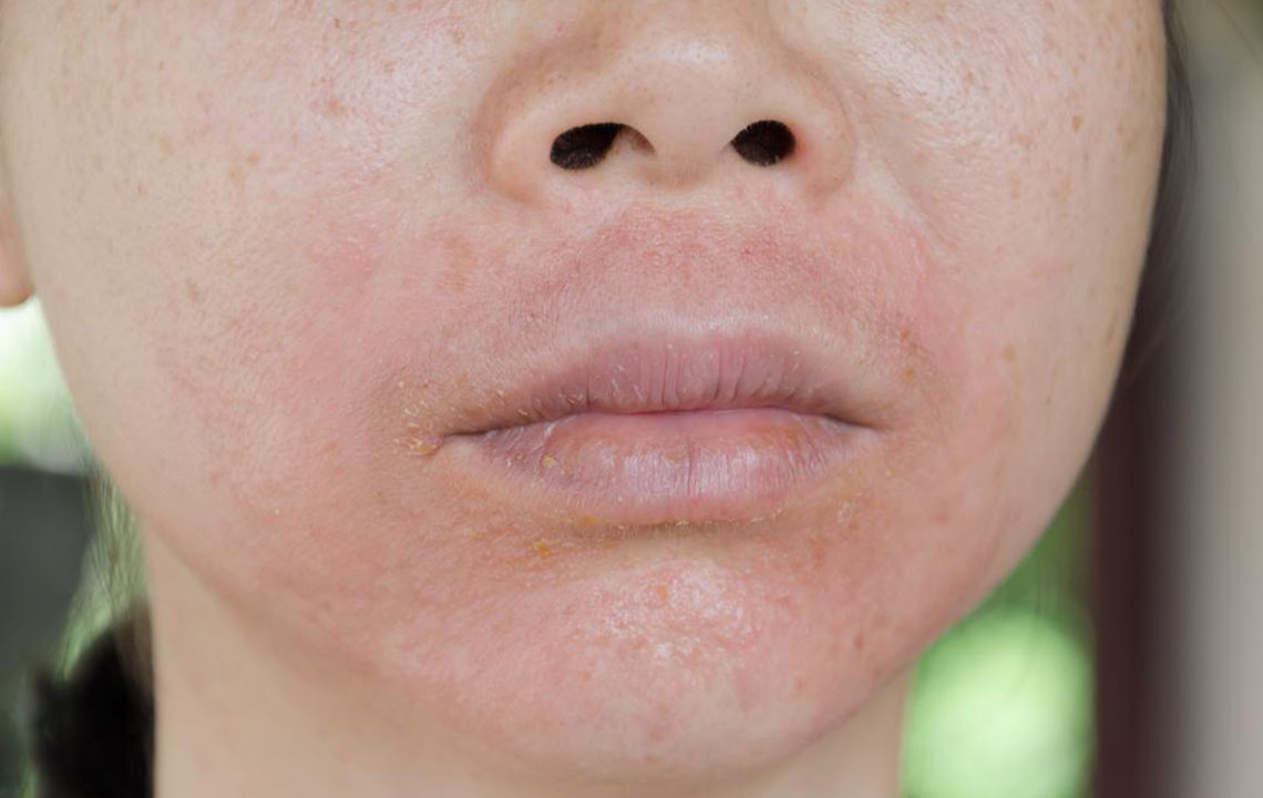 Top Strategies for Managing Eczema Symptoms