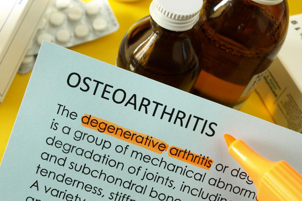 Effective Strategies for Managing Knee Osteoarthritis