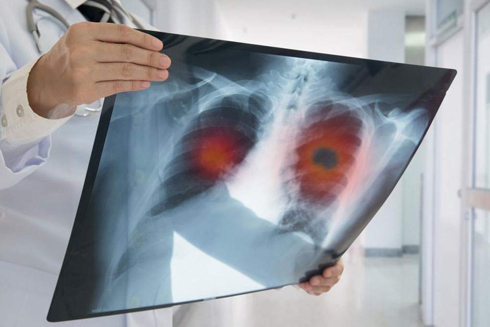 Support Resources for Lung Cancer Patients: Essential Help and Guidance