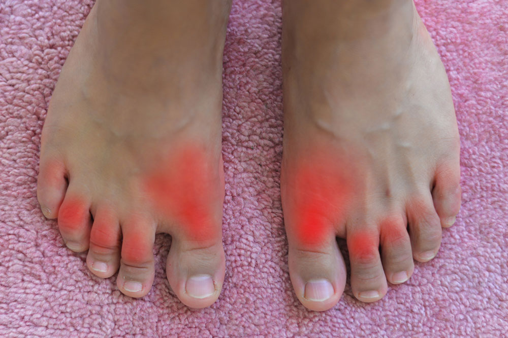 Comprehensive Guide to Gout: Causes, Symptoms, and Treatments
