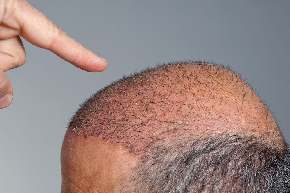 Understanding the True Cost of Hair Transplant Procedures