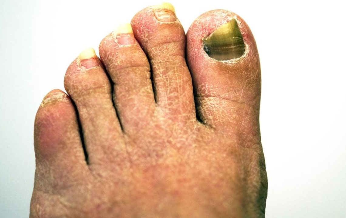Effective Strategies to Eliminate Toenail Fungal Infections