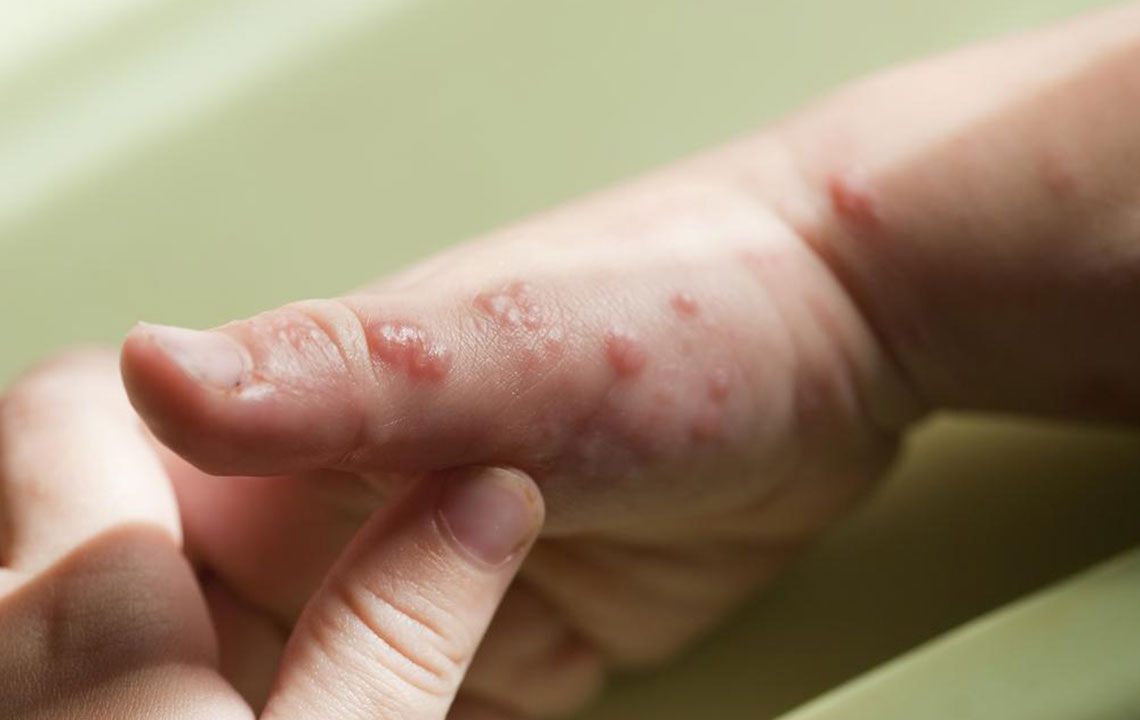 Effective Strategies for Managing Shingles Discomfort