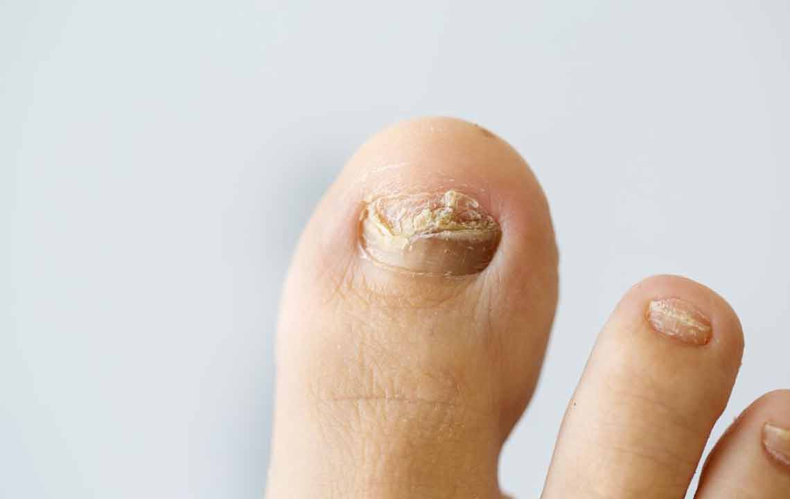 Effective Strategies for Treating Nail Fungal Infections