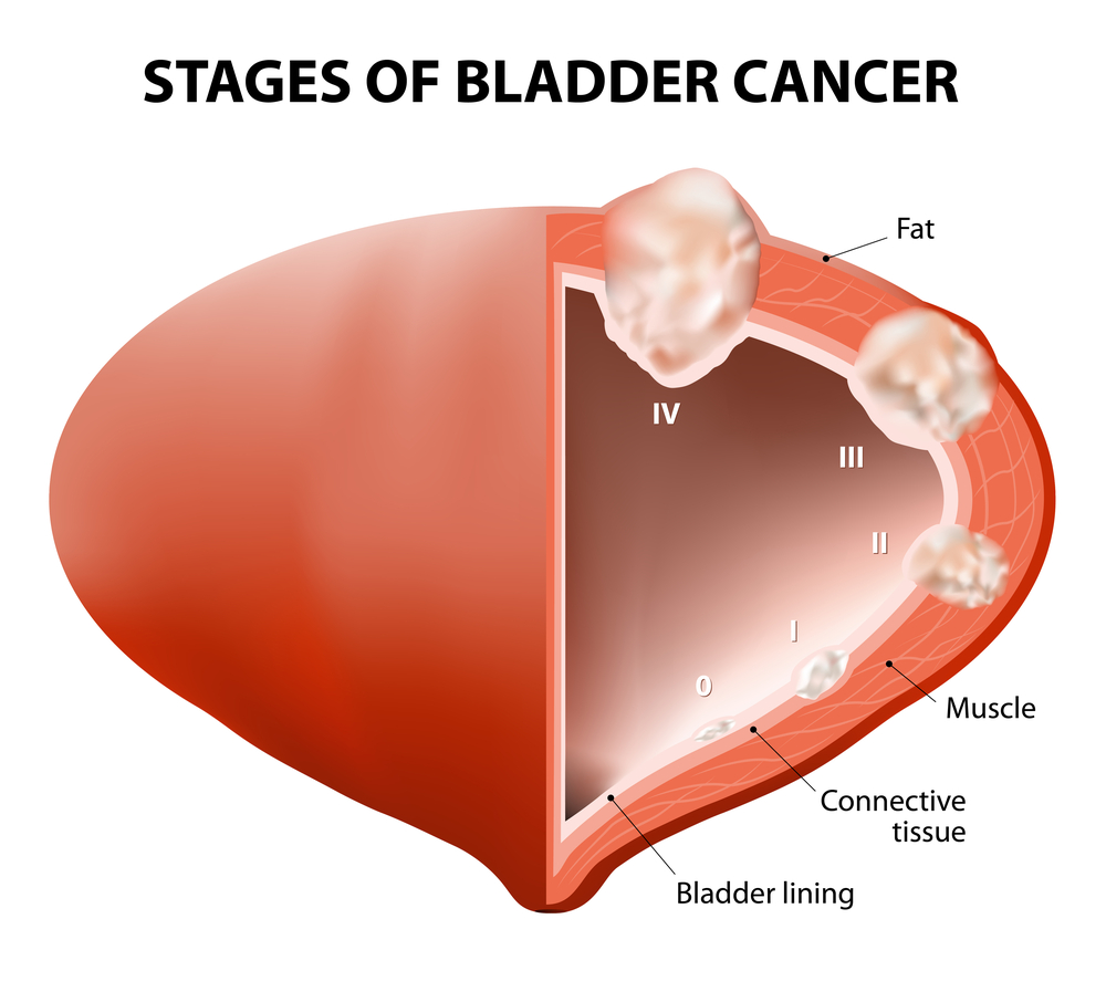 Comprehensive Guide to Bladder Cancer: Causes, Symptoms, and Treatment Options