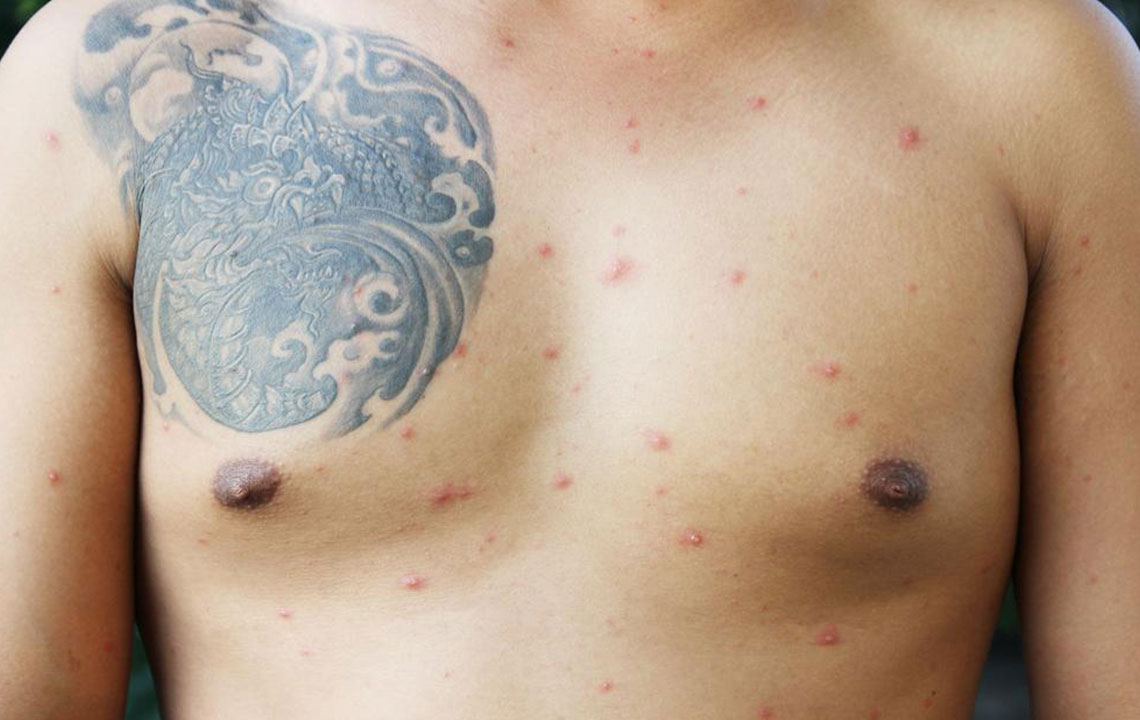Top Strategies to Guard Against Shingles Outbreaks