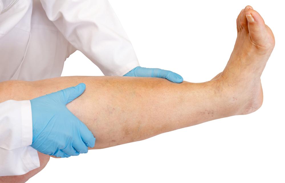 Understanding Deep Vein Thrombosis: Signs, Diagnosis, and Management