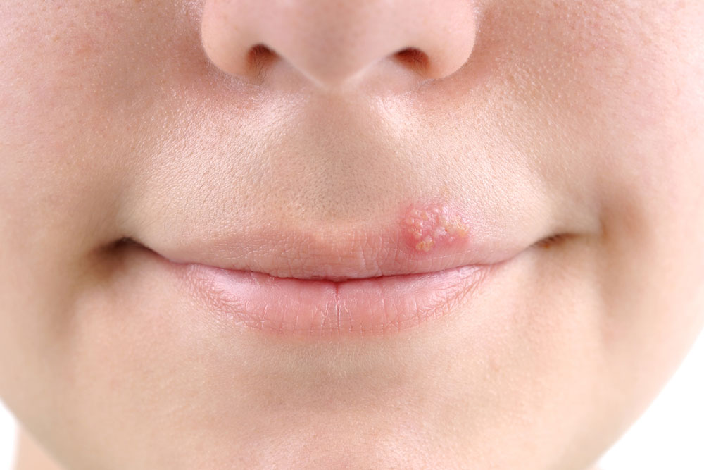 Effective Strategies for Cold Sore Recovery