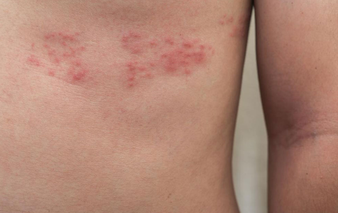 Effective Natural Approaches to Manage Shingles Discomfort