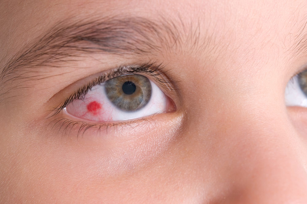 Complete Guide to Eye Infections: Symptoms, Causes, and Prevention Strategies to Safeguard Your Vision