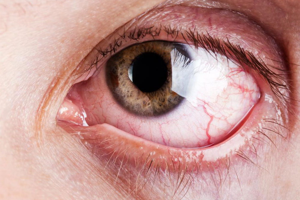 Understanding the Symptoms and Causes of Graves' Disease