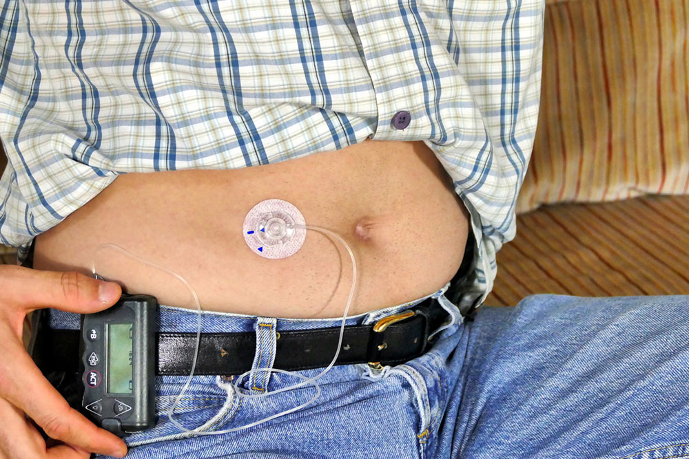 Cutting-Edge Insulin Delivery Technologies to Optimize Type 1 Diabetes Management