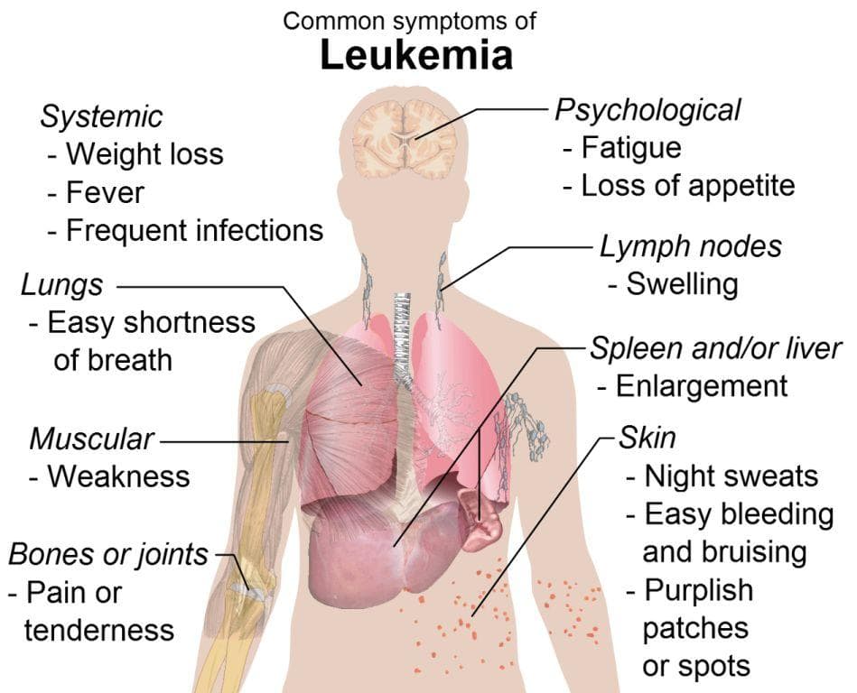 Recognize These Signs: Early Indicators of Leukemia in Your Body