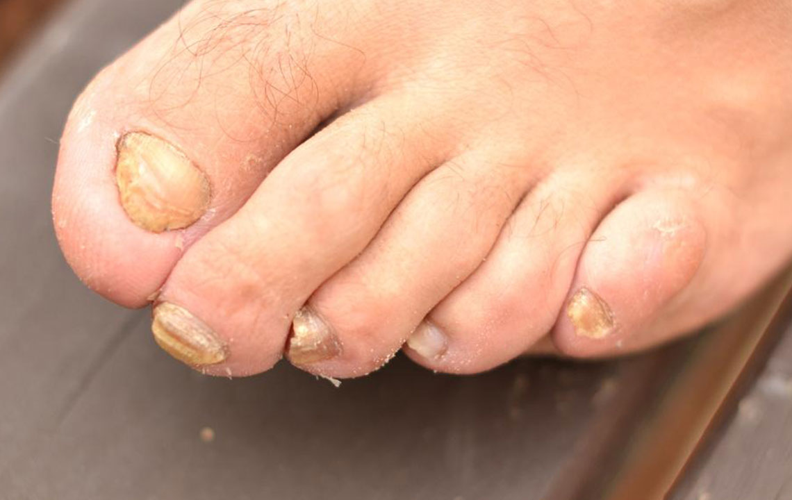 Understanding Toenail Fungus: Causes, Signs, and Remedies