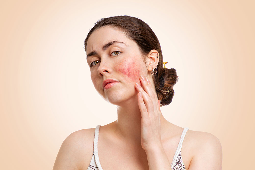 Understanding Rosacea: Types and Effective Management Strategies