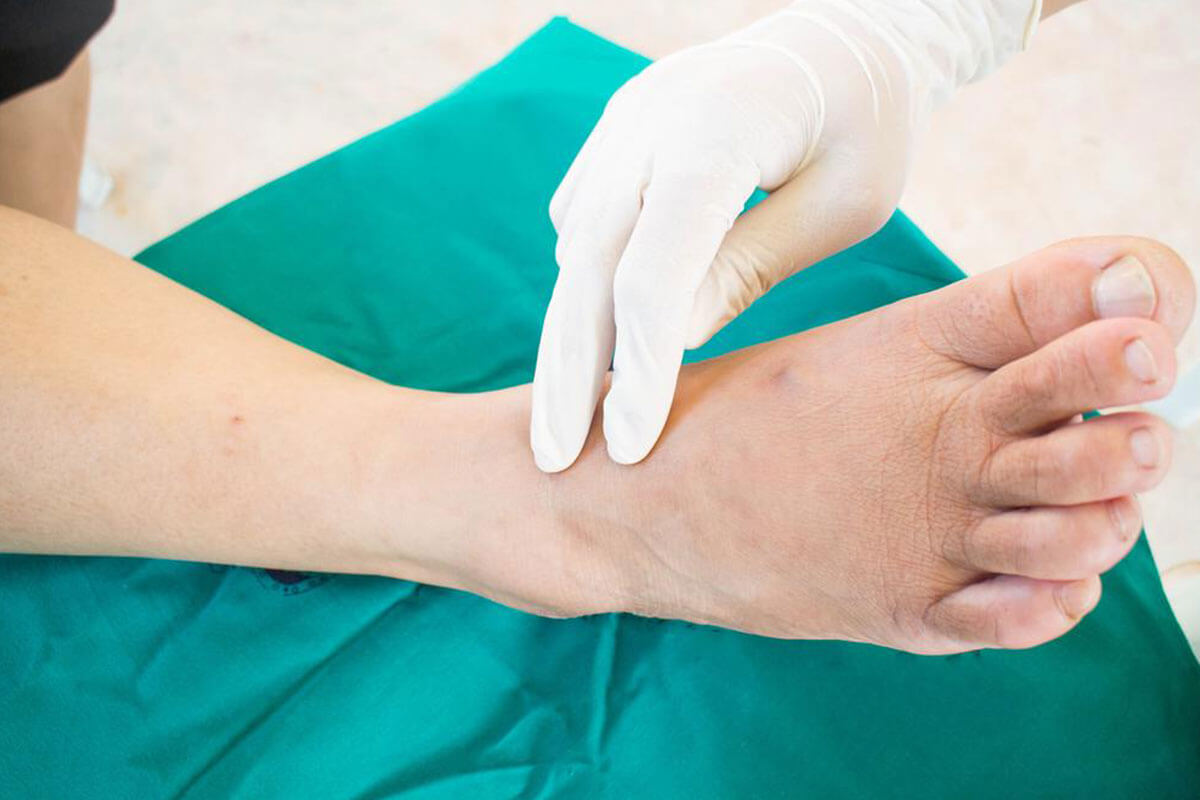 Effective Strategies for Managing Diabetic Foot Health