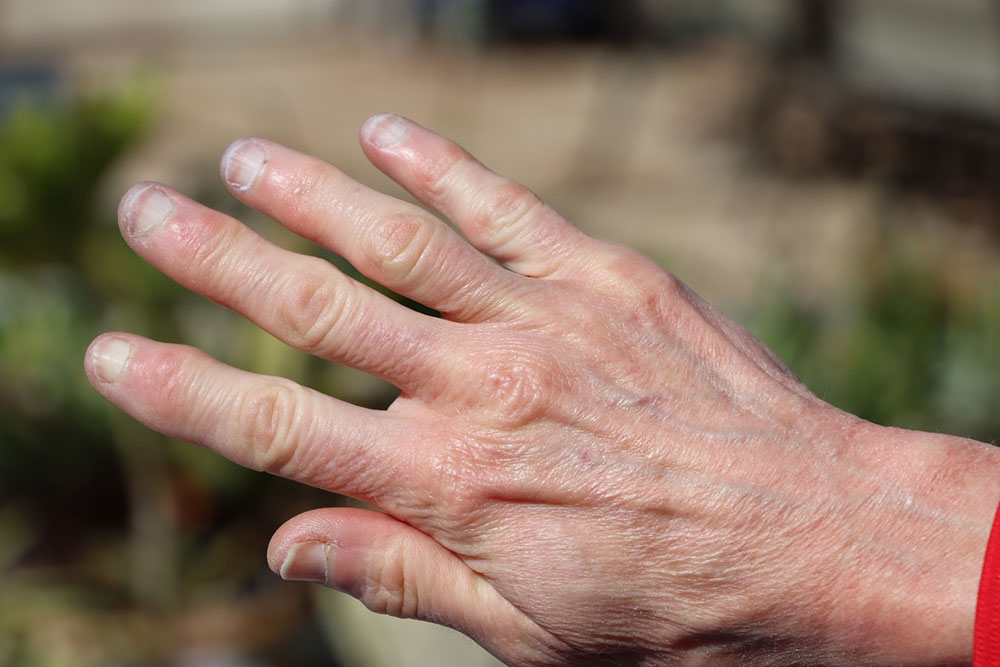 Understanding Heberden’s Nodes: Symptoms and Treatment Strategies