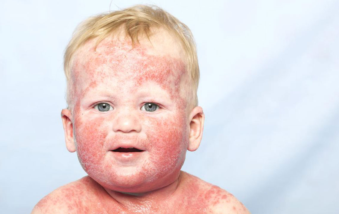 Top 7 Natural Remedies for Managing Atopic Dermatitis