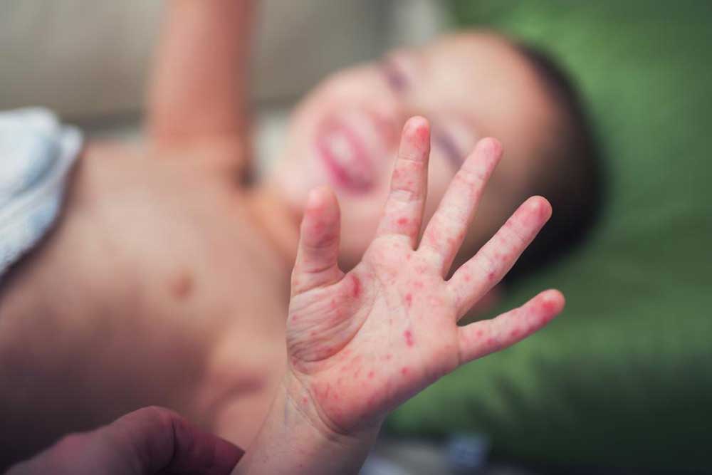 Essential Preventive Strategies Against Hand, Foot, and Mouth Disease