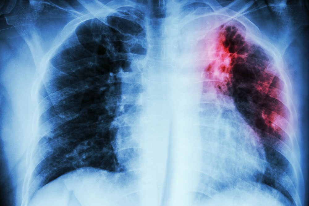 Understanding Pulmonary Embolism: Symptoms and Diagnostic Approaches