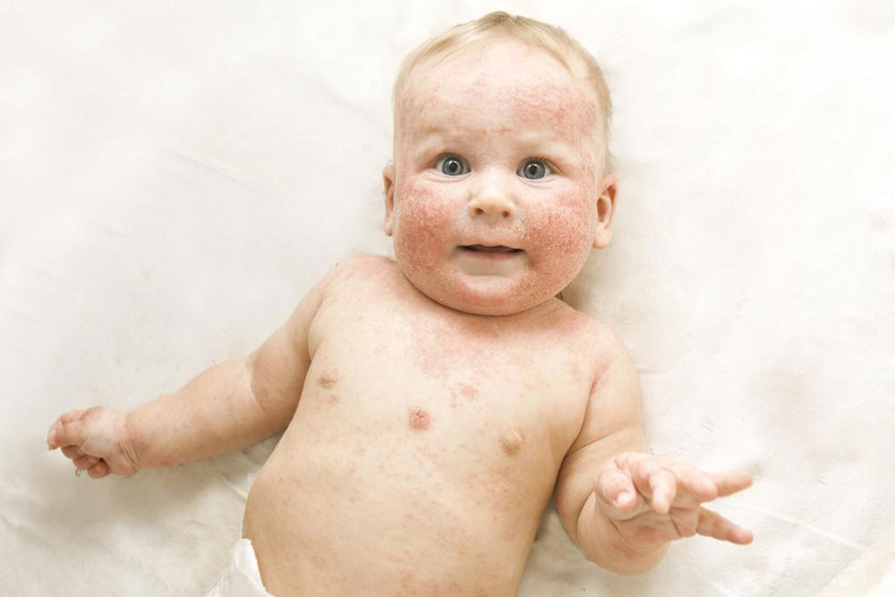 Comprehensive Guide to Managing Atopic Dermatitis