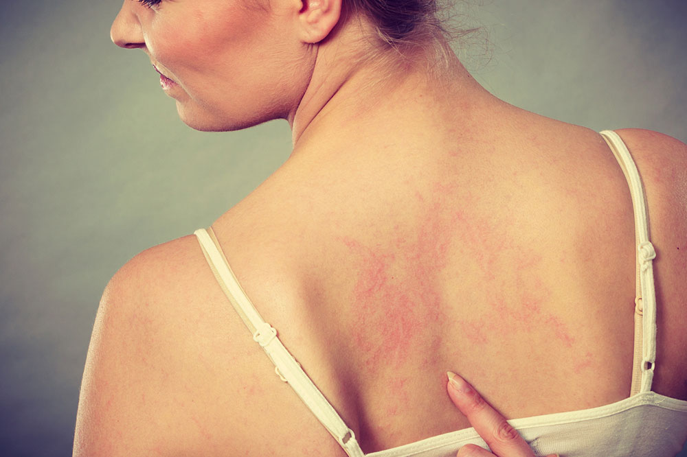Understanding the 5 Major Types of Psoriasis
