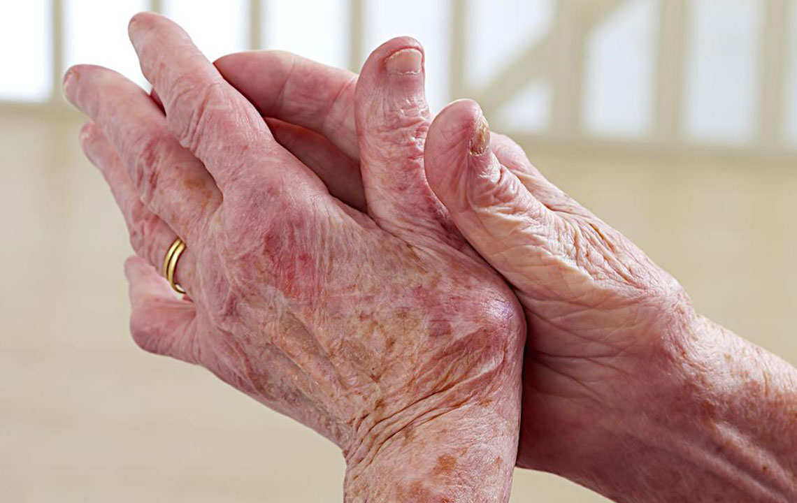 Understanding Lupus: Symptoms and Prevention Strategies
