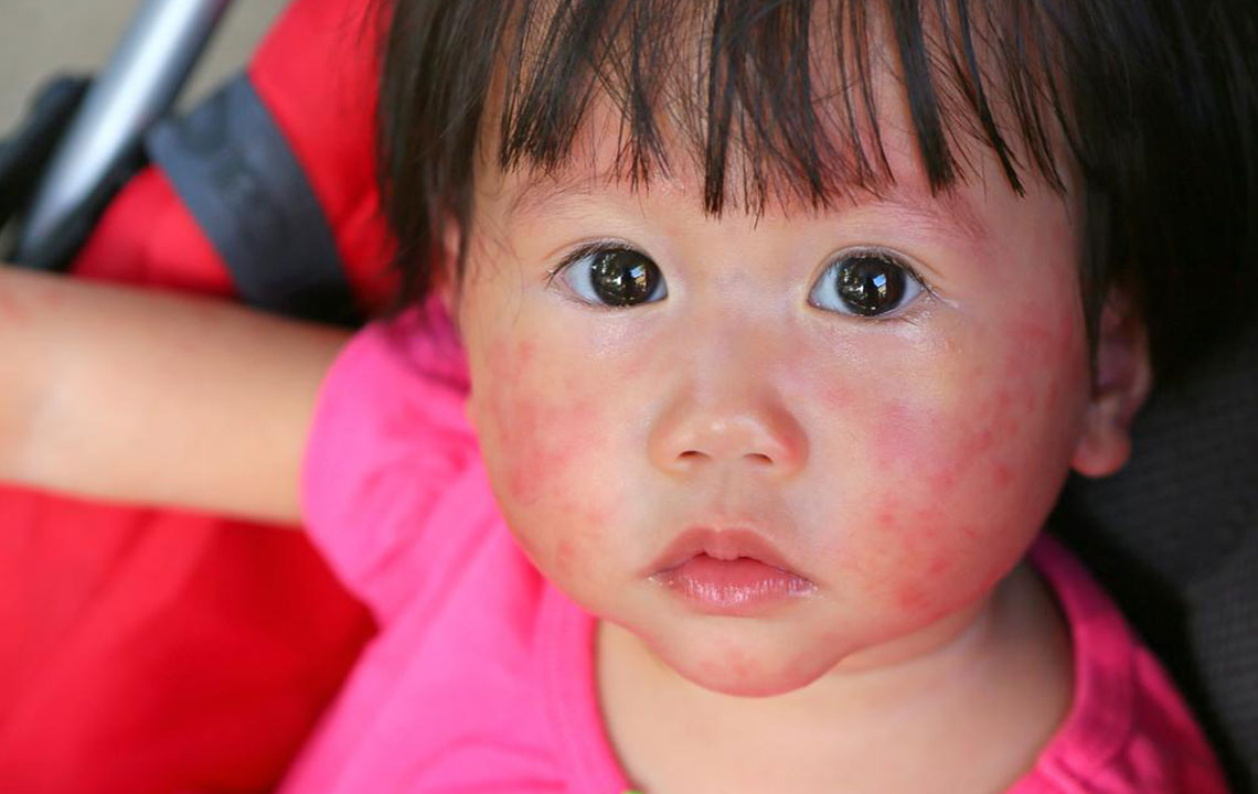  Recognizing the Key Indicators of Lupus You Should Know