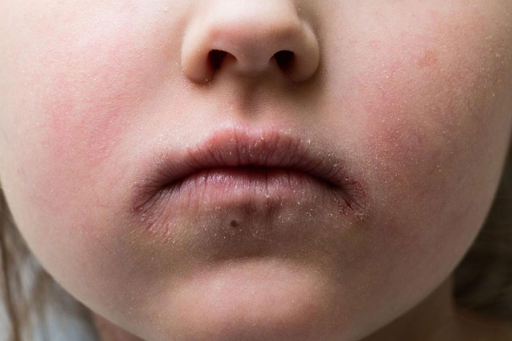 Causes and Prevention of Impetigo in Children and Adults
