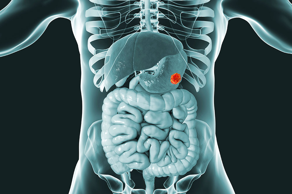 Understanding Gastrointestinal Stromal Tumors (GIST): Symptoms, Causes, and Treatment Options