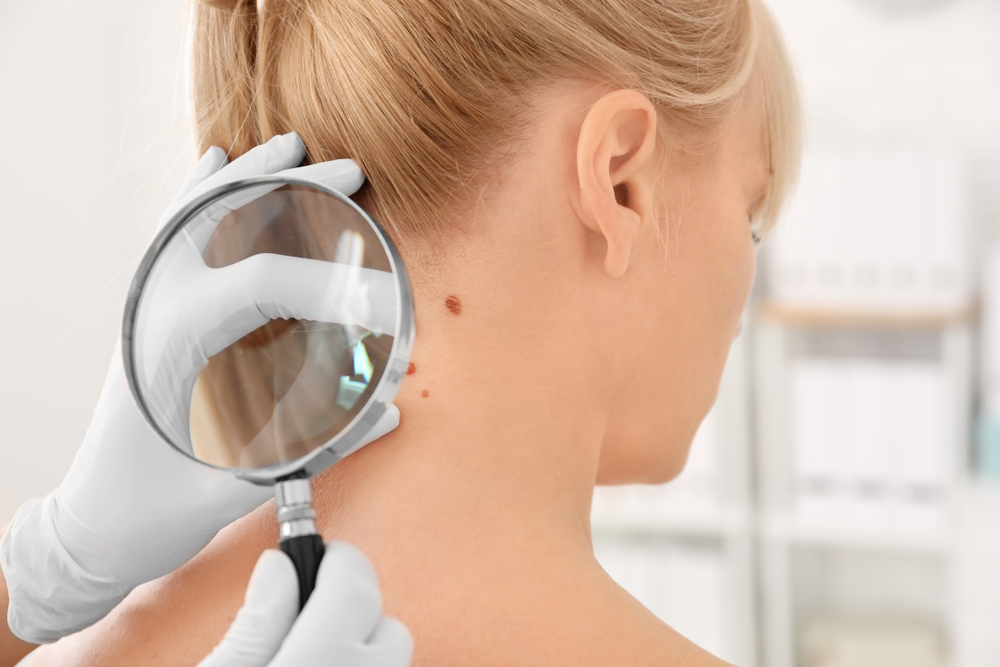 Essential Facts About Skin Cancer You Should Know