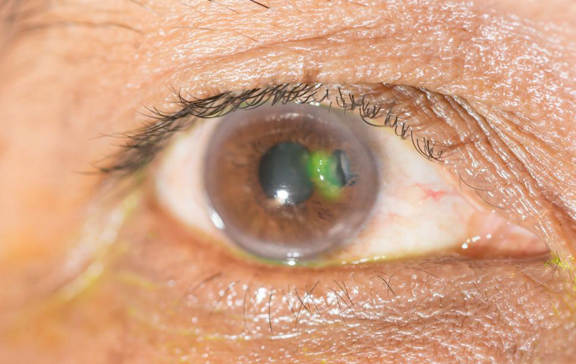 Common Eye Conditions and Their Signs