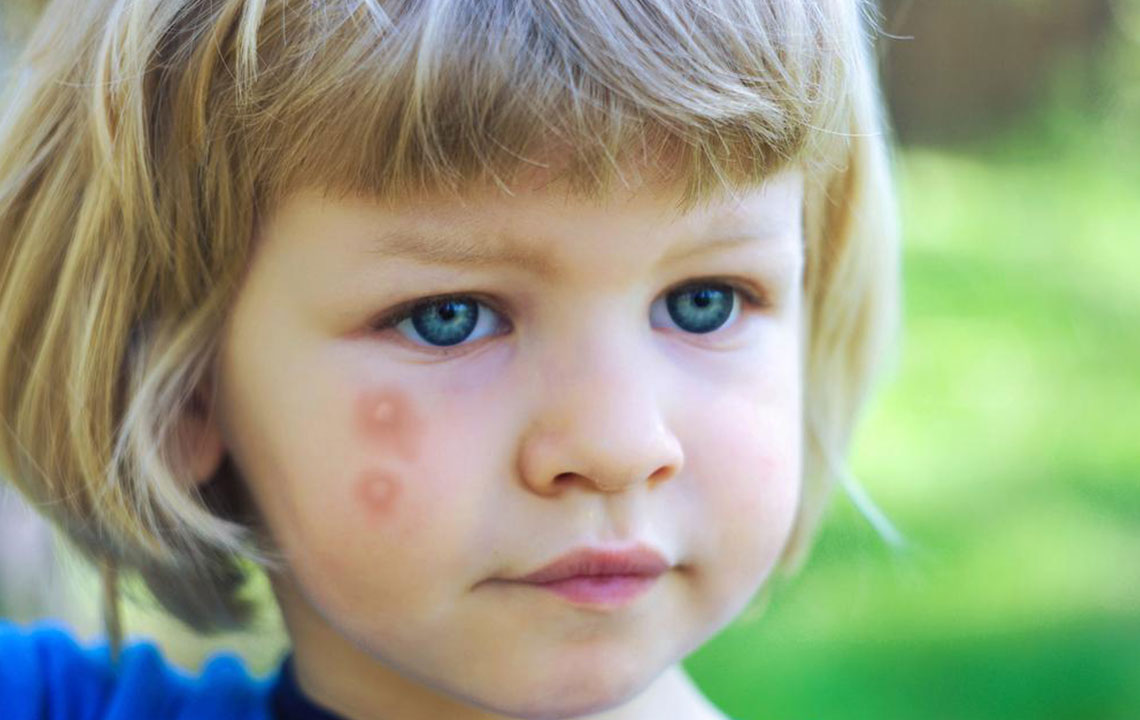 Comprehensive Guide to Identifying Insect Bites and Stings for Effective Treatment