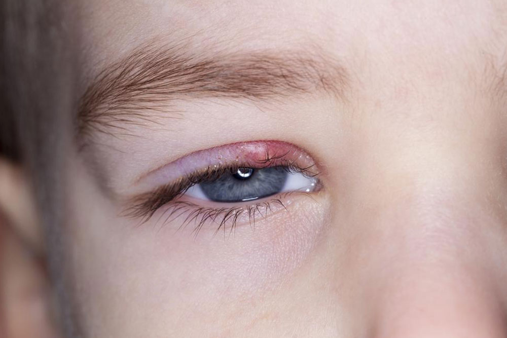 Comprehensive Home Remedies and Treatments for Styes: Safe & Natural Approaches