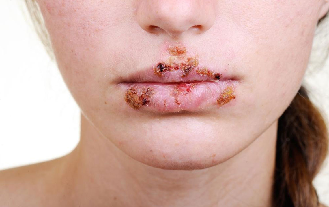 Effective Strategies for Managing Herpes Flare-Ups