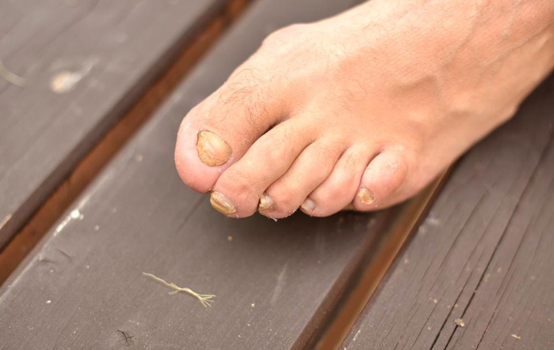 Effective Natural Treatments for Toenail Fungal Infection