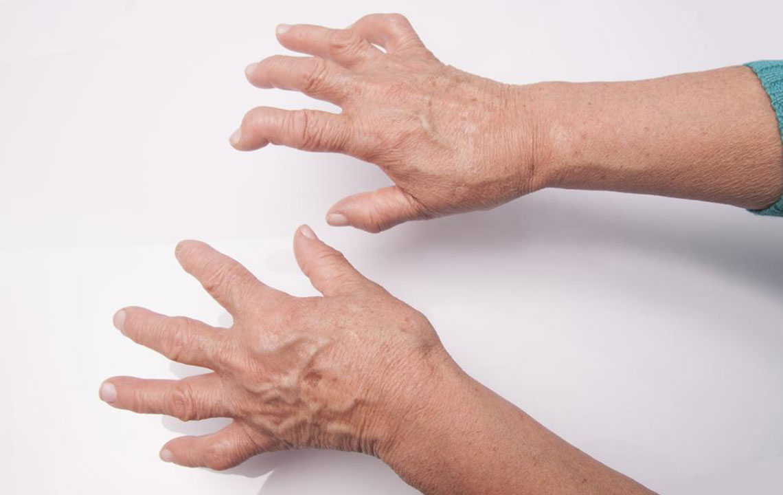 Essential Insights Into Rheumatoid Arthritis Symptoms and Management
